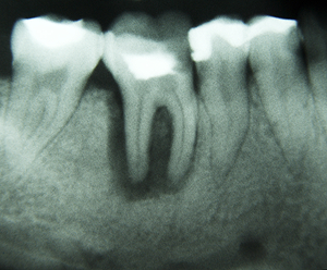 Ząb trzonowy z rozlegą zmianą okołowierzchołkową.