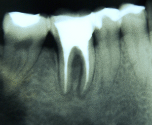 Ten sam ząb po roku od nowoczesnego
leczenia endodontycznego.