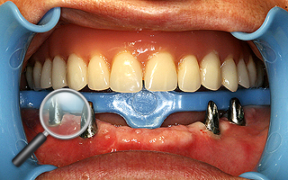 3b. Abutmenty przykręcone do implantów w jamie ustnej