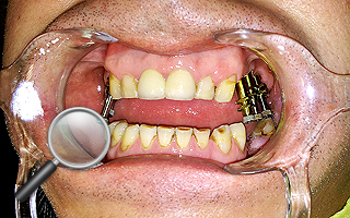 5a. Wprowadzono implanty zębowe - wystające śruby to dokręcone transfery wyciskowe do wykonania implantokoron