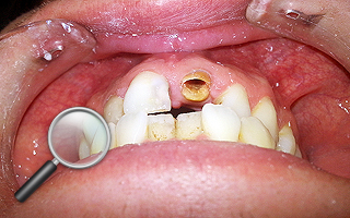 12a. Pacjent zgłosił się celem usunięcia zniszczonego korzenia zęba jedynki. Zdecydowano się uratować korzeń !!!