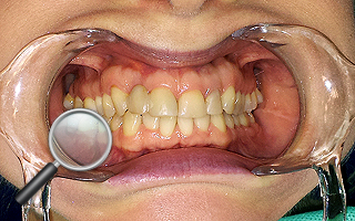 4a. Pacjentka z nieestetycznymi wypełnieniami w odcinku przednim, z tzw. wysoką linią uśmiechu (bardzo widoczne dziąsła) - przed leczeniem