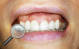 4b. Gotowe korony pełnoceramiczne na zębach przednich(od trójki do trójki)