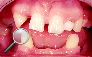 5a. Stan przed leczeniem