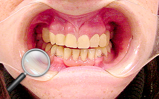 5c. Uzupełnienia tymczasowe na okres leczenia