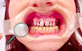 5d. Próba struktury metalowej mostu porcelanowego górnego