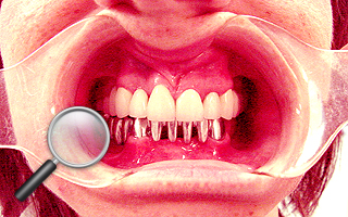 5e. Gotowy most porcelanowy górny i próba struktury metalowej dolnej